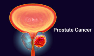 Prostate cancer diagnoses set to double by 2040 particularly in low income countries – Study 