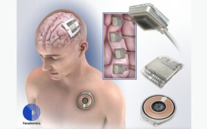 Neurotech startup Paradromics to launch $100,000 neural implant in humans 2025