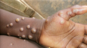 Africa requires over $220 million to sustain Mpox response – Africa CDC, WHO 