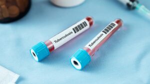 Over 50,000 Nigerians test positive for tuberculosis amid nationwide screening – Global Fund